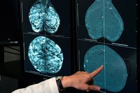 Mammography: Your Essential Guide to Breast Cancer Screening & Early Detection